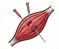 Dry needling treatment for muscle tension relief